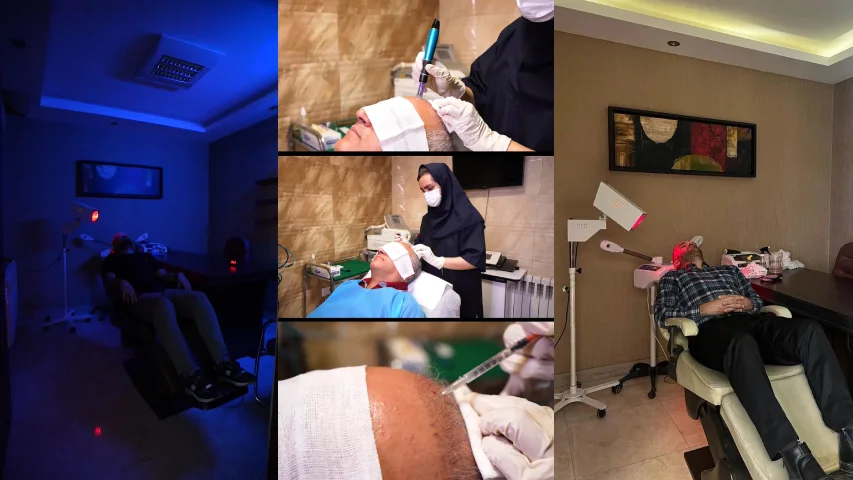 کاشت مو آفتاب در اصفهان